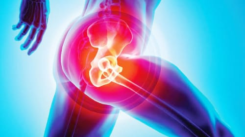 Best Hip Replacement in Lahore