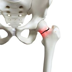 Hip Replacement in Lahore pakistan