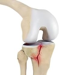 knee replacement lahore