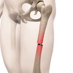 fracture